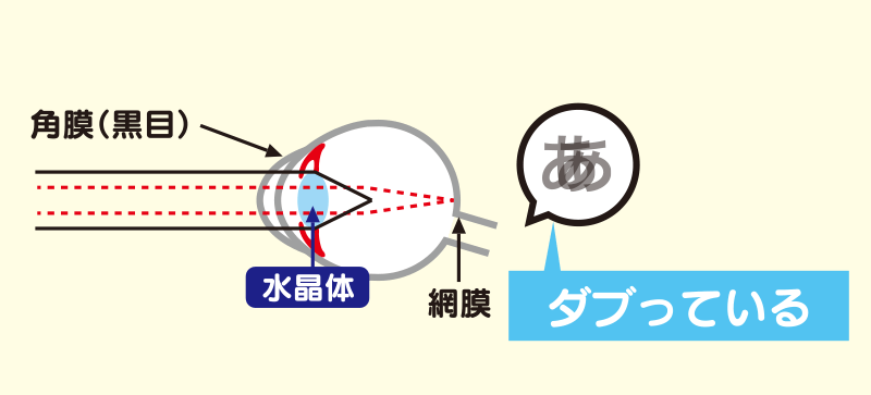 戸塚モディ眼科の「目の病気」画像